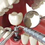 Dental implants - a solution for individuals with missing teeth